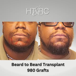 Did you know we do beard transplants? 
🧔‍♂️Patchy beards are pretty common, and patients travel to 
