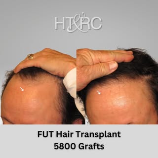 🎉 We are absolutely thrilled to share these incredible results from one of our recent hair transpla