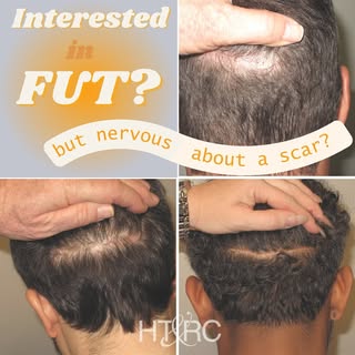 🌟✨ Let’s talk about FUT linear scars and what they mean for those considering a hair transplant! 🌱
