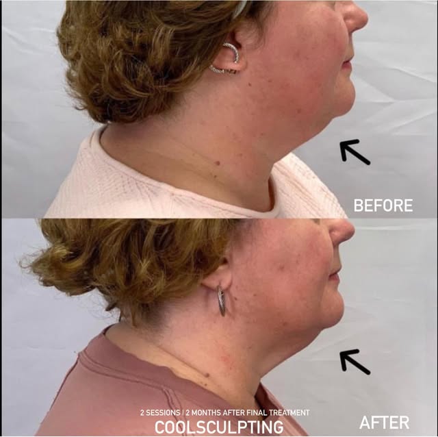 This patient’s main concern was fullness under the chin.

We treated the area from the jawline throu