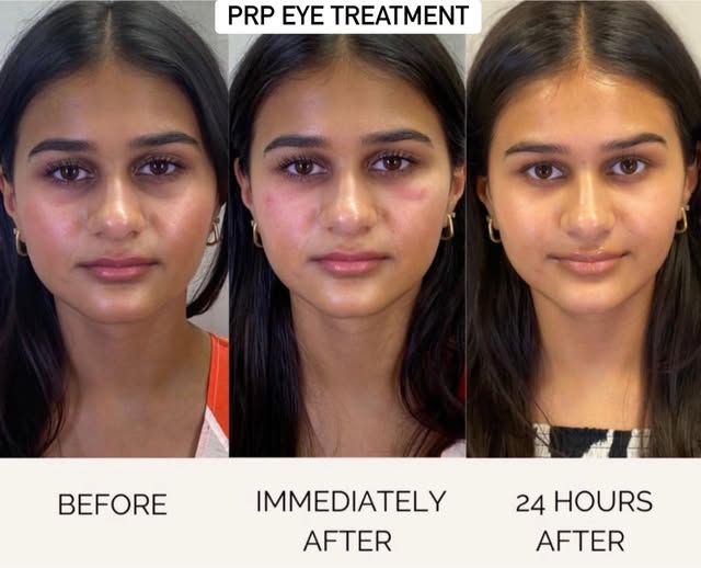 Dark circles can happen for many different reasons, which is why the consultation matters.

In this 