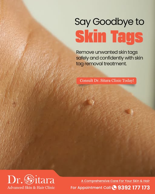 Say Goodbye to Skin Tags! 

Skin tags are small, harmless growths that commonly appear on the neck, 