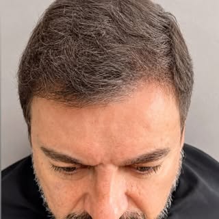 6 meses após o transplante capilar. Um resultado que já mostra naturalidade, melhora global do cabel
