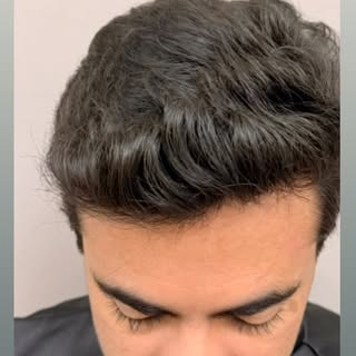 2 anos pós-transplante capilar. Veja a naturalidade do resultado.