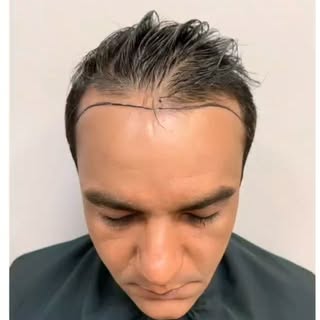 #transplantecapilar #drthiagoschreiber #clinicadermagem #setelagoas