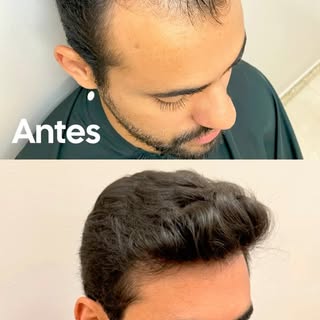 Olha esse antes e depois após o transplante capilar.

Observe a naturalidade da linha frontal e a al