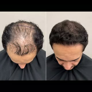 #transplantecapilar #drthiagoschreiber #setelagoas #clinicadermagem