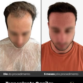 • Transplante capilar - FUE 
• As imagens demonstram a evolução individual de um paciente após o pro