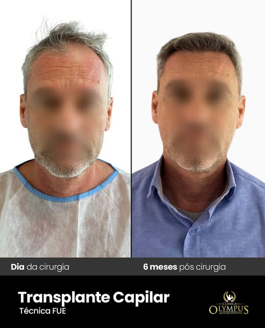 • Transplante capilar - FUE 
• Mais um belo resultado. Naturalidade e ultra densidade de fios. 

• I