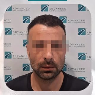 Rezultati koji vraćaju prirodan izgled i samopouzdanje.

Transplantacija kose nije samo promena izgl