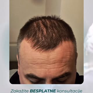Pre i posle transformacija koja pokazuje koliko stručan pristup pravi razliku.

Kada se transplantac