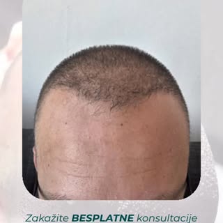 Nekada je dovoljna jedna fotografija da pokaže razliku.

Pre i posle rezultat našeg klijenta pokazuj