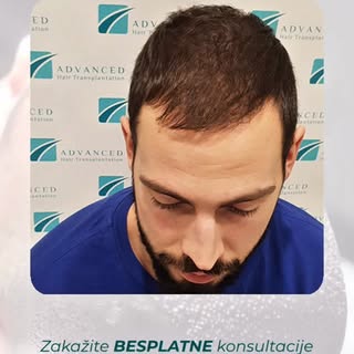 Rezultati ne nastaju slučajno.

Iza svake uspešne transplantacije kose stoje iskustvo, preciznost i 