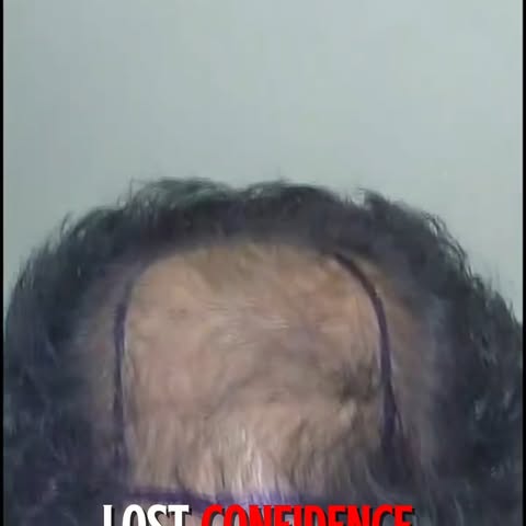 Hair thinning? Receding hairline?
Get a permanent, natural solution with our advanced Hair Transplan