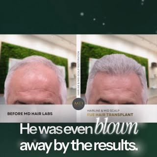 Let’s take deep dive into the planning of our hair restoration patient! Before & After! 🎥 #hairrest