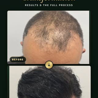 Before → After. Not all hair transplants are created equal. The technology, the protocol, the hands 