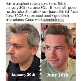 What do u guys think?!??? Wowwwwwwwww @mdhairlabs this is incredible!!! 
.
Hair transplant results t