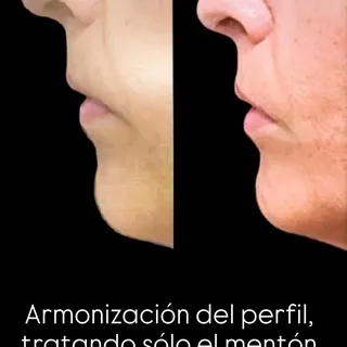 El mentón juega un rol importante en la armonía del perfil facial. Infiltrarlo de forma estratégica 