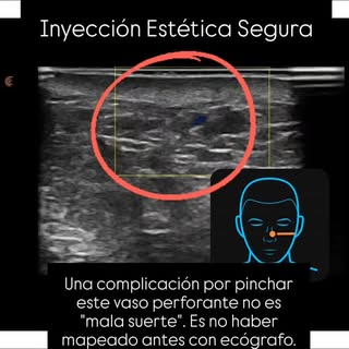 Inyectar sobre un vaso perforante como el de la imagen, los que suben a la superficie de la piel par