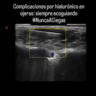 El tratamiento infiltrativo de complicaciones estéticas debe ser siempre preciso y seguro: siempre e