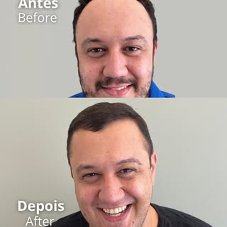Dr. Décio Montresor — CRM 129016/SP 

Transplante Capilar • Jundiaí/SP

⚜️ Realizamos apenas UMA cir