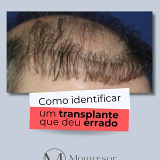 Um transplante capilar de qualidade não deve chamar atenção pelos fios implantados, mas pela natural