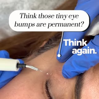 Think those tiny bumps around your eyes are permanent? Think again. 👀✨

Those small, stubborn white