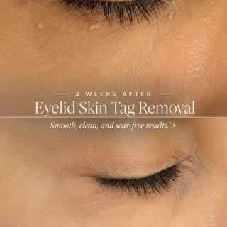 Think those tiny bumps around your eyes are permanent? Think again. 👀✨

Those small, stubborn white