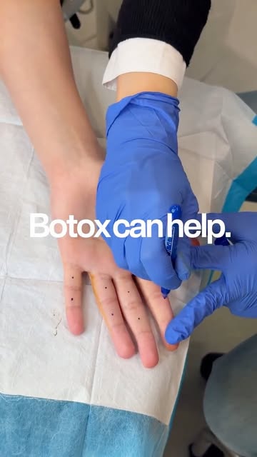 💦 Do you struggle with excessive sweating? Botox may be the solution you’ve been looking for.
Hyper
