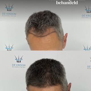 Een natuurlijk resultaat staat altijd voorop.

Bij deze haartransplantatie is de voorkant mooi opgev