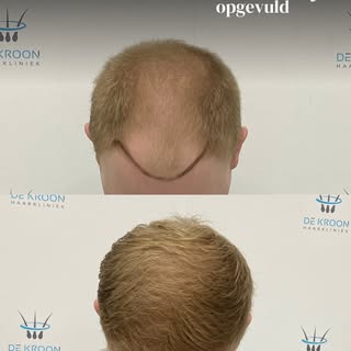Een natuurlijk resultaat staat altijd voorop. 

Bij deze haartransplantatie hebben we de voorkant op