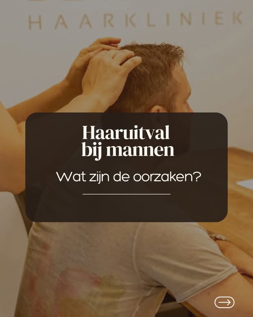 Haaruitval bij mannen is vaak erfelijk, maar kan ook andere oorzaken hebben. Denk aan stress, een ij