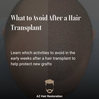 In the first couple of weeks after a hair transplant, new grafts are delicate and need time to settl