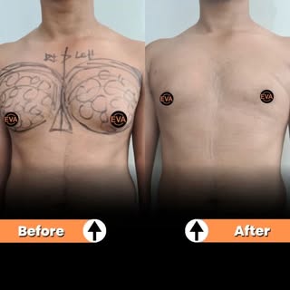 drhiranmayijhaplasticsurgeon 🎯Target area: male chest
Treatment:Gynecomastia surgery 
Results: imme