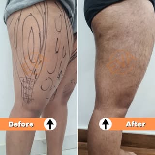 Uncover the power of transformation! Thigh liposuction at Eva Clinic, performed by Dr. Hiranmayi Jha
