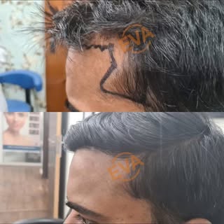 Transforming confidence, one strand at a time! 🌟 Check out these amazing hair transplant results at