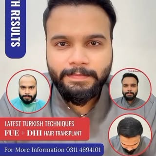💥⚡See the Magic of FUE + DHI | Real Results, Real Confidence! 💇‍♂🔥

Hear from real patients about