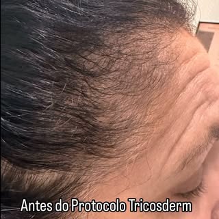 “ Veja esta incrível transformação de uma paciente que sofria de queda de cabelo e baixa autoestima 