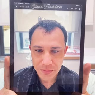 “Renove-se : Da queda à glória em 9 meses de transplante capilar! 💇✨A mudança que você precisa para