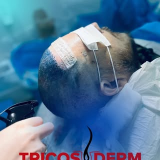 “Recupere sua confiança e autoestima com o transplante capilar! 🌱💇‍♂️ Volte a se sentir incrível �