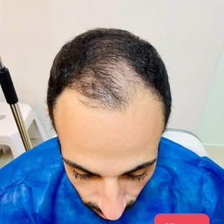Transplante Capilar: Recupere sua Confiança e Autoestima! 💇‍♂️✨

Pensando em fazer um transplante c