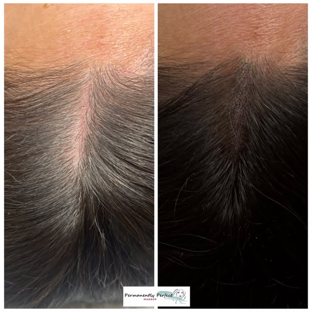 SCALP MICROPIGMENTATION | BEFORE & AFTER ✨

A subtle transformation that makes a BIG difference! 👏

