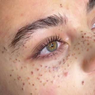 💛 Faux Freckles ☀️

Zij had al sproetjes laten zetten bij een andere kliniek, ik heb ze wat meer va