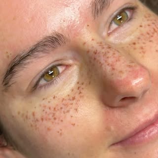 Faux Freckles ✨

▫️Handpoke + Machine combo
▫️Direct na de behandeling ziet het er intens uit, dit v