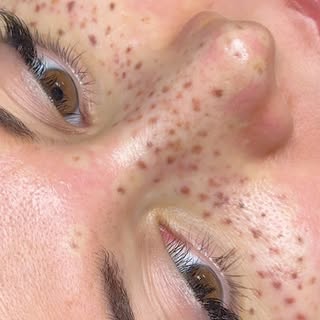 Faux Freckles by Leau Clinic 💫

▫️Handpoke 
▫️Signature (S/M) Pakket
📍 Rotterdam

#fauxfreckles #p