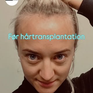Hårtab rammer også kvinder – 🌸 Hos Novohair tilbyder vi hårtransplantationer designet til at give d