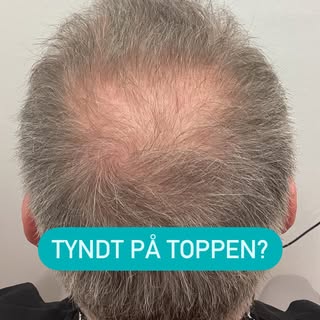 Før og efter hårtransplantation

Book en gratis konsultation i dag

💌info@novohair.dk
📞+4542909892