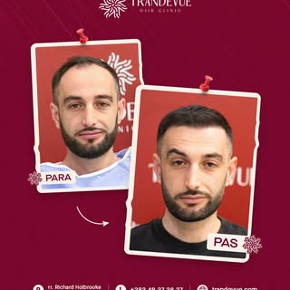 Rezultat natyral, vijë e re dhe dendësi që bën diferencën, 9 muaj pas mbjelljes së flokëve në Trande