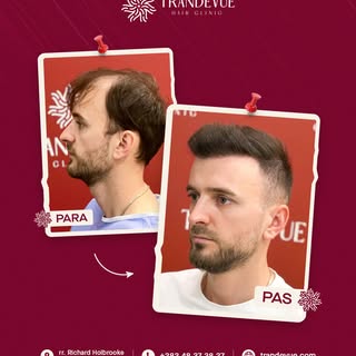 Vetëm 8 muaj pas mbjelljes së flokëve, rezultati flet vetë, më shumë dendësi, vijë natyrale dhe një 