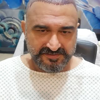 Mr Ajmal From KSA sharing his Experience of Hair Transplants at Advancedhaircentre Contact: 03097199